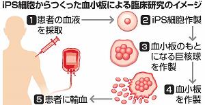 iPS細胞からつくった血小板による臨床研究のイメージ